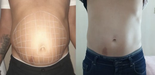 Antes e depois de abdômen com protocolo Lipo HD Enzimática
