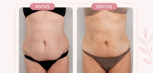 Antes e depois de contorno corporal