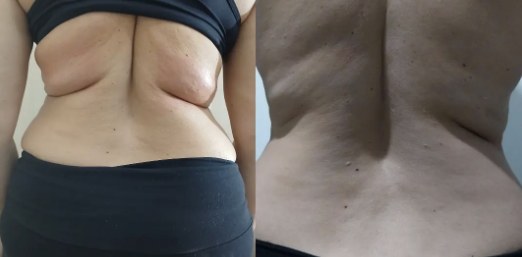 Antes e depois de costas e flancos após protocolo corporal